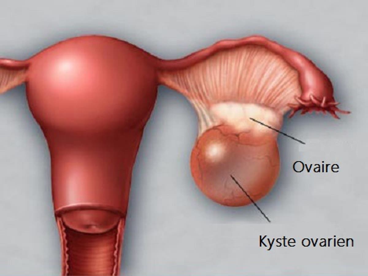 Les kystes ovariens